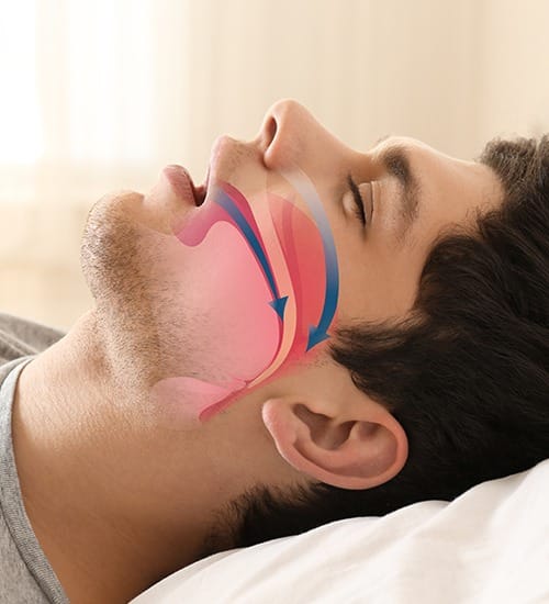 Man in need of sleep apnea therapy with animated airway over his profile