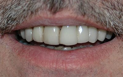 Discolored teeth before dental treatment