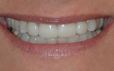 Top tooth whitened and healthy after cosmetic dentistry