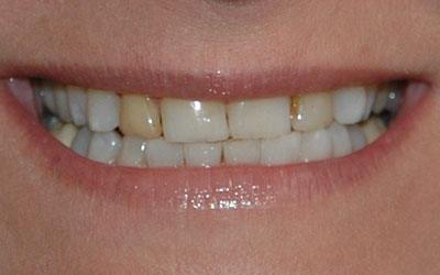 Yellow colored top tooth before cosmetic dentistry