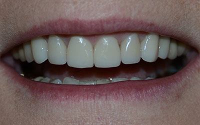 Bright white and healthy teeth after dental treatment
