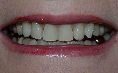 Disocolored and worn teeth before dental treatment