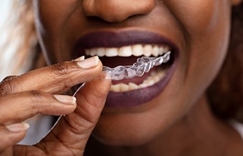 Close-up of a woman putting in a clear aligner in San Ramon, CA
