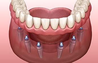 Illustration of full implant dentures for lower arch