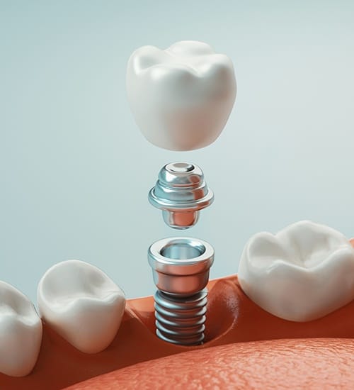 Animated dental implant supported tooth replacement