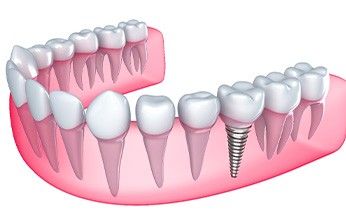 Illustration of a single dental implant in the lower arch