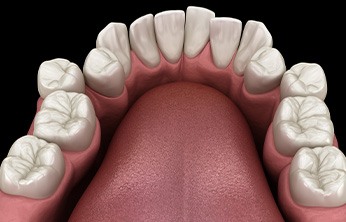 Illustration of crowded teeth viewed from back