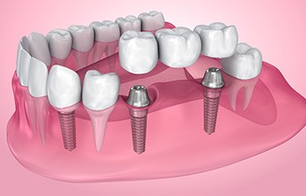 Illustration of dental bridge being attached to dental implants