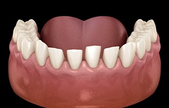 Illustration of gaps between lower teeth