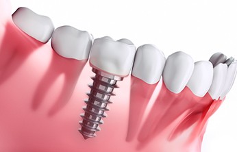 3D illustration of a dental implant with a crown on top 
