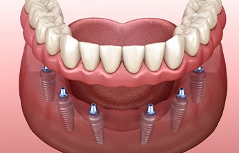Illustration of dentures being attached to dental implants in lower arch