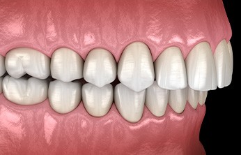 Illustration of overbite viewed from side