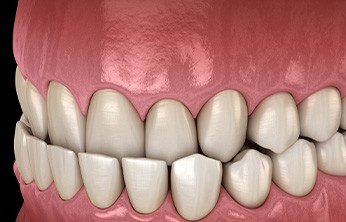 Illustration of underbite viewed from side at a slight angle