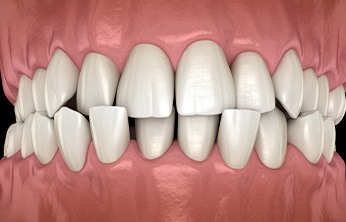 Illustration of head-on view of crossbite