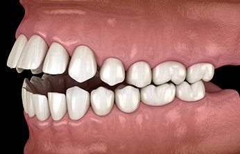Illustration of open bite viewed from side