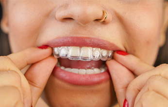 Woman placing clear aligners on upper teeth