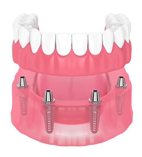 3D illustration of an All-on-4 denture
