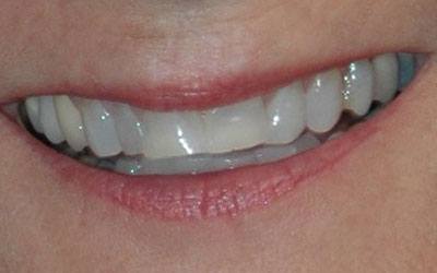 Damaged smile before dental treatment
