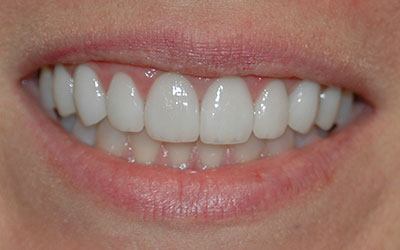 Brilliant white smile after teeth whitening