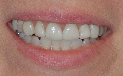 Yellowed smile before teeth whitening