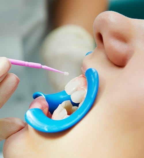 Patient receiving fluoride treatment