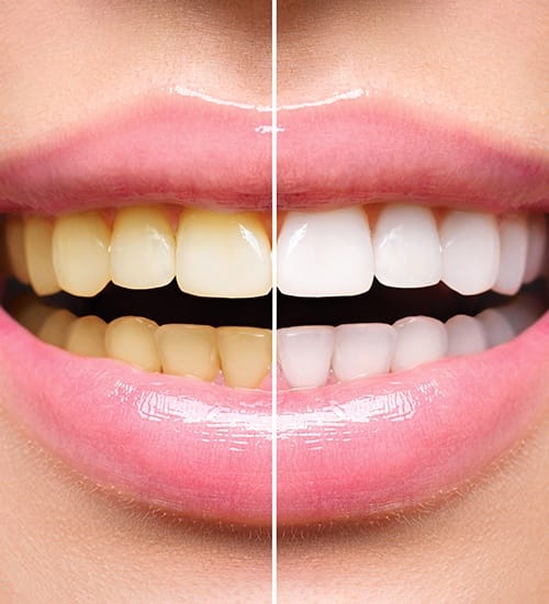 Smile before and after teeth whitening