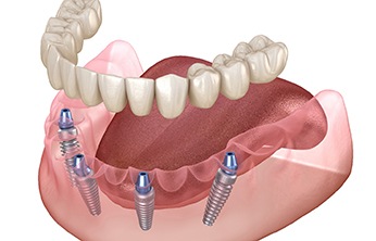 Illustration of All-on-4 dentures in San Ramon, CA