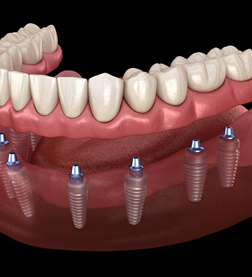 Illustration of implant dentures in San Ramon being attached to lower arch