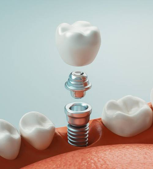 model of how dental implants in San Ramon work