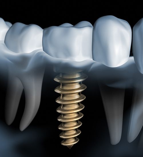 X-ray of a patient with a dental implant