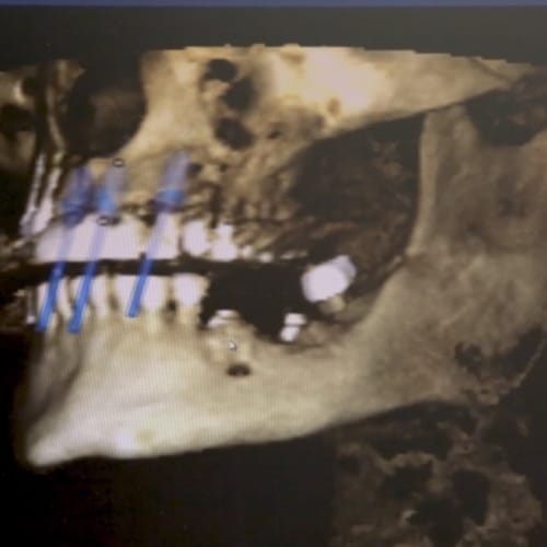 Digital x-rays of jaw and skull used for treatment planning