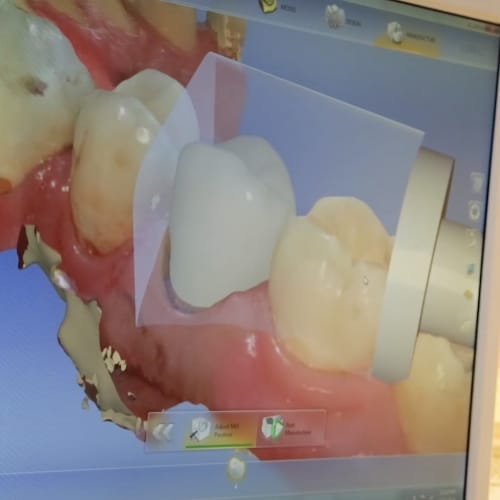 Digital bite impression and dental restoration design on dental computer screen