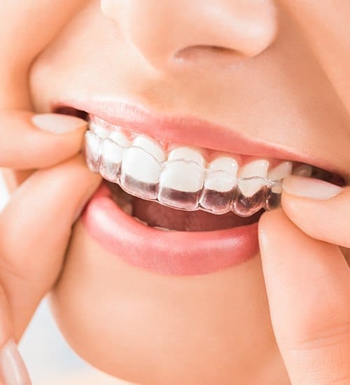 Closeup of patient placing orthodontic clear aligner