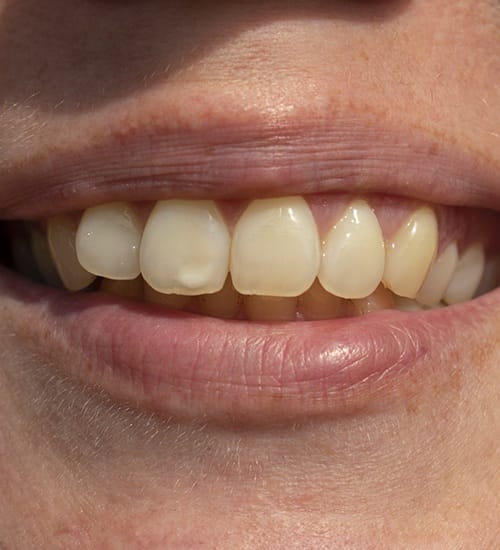 Discolored smile in need of makeover