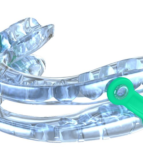 Close-up of a sleep apnea oral appliance in San Ramon, CA