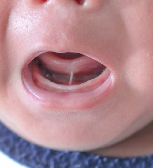 Close-up of infant with tongue-tie in San Ramon