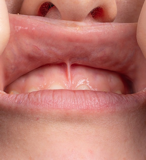 Pulling up lip to show lip-tie