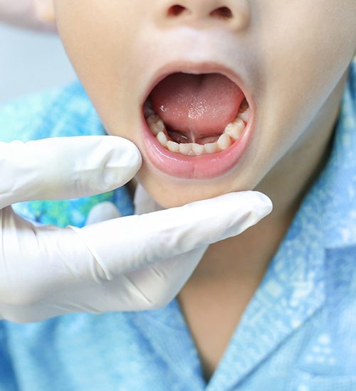 Child opening mouth to show lip-tie