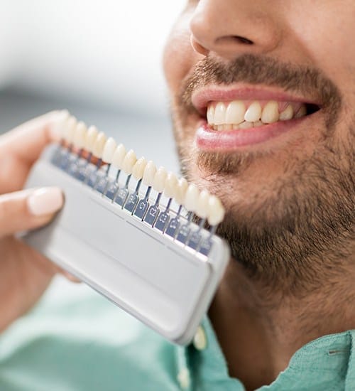 Smile compared with porcelain veneer shade chart