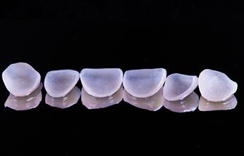 Six veneers in San Ramon, CA sitting in a row