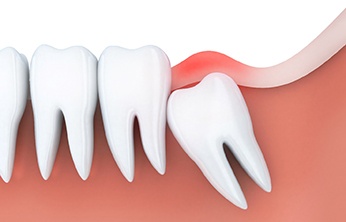 Illustration of impacted wisdom tooth in San Ramon, CA