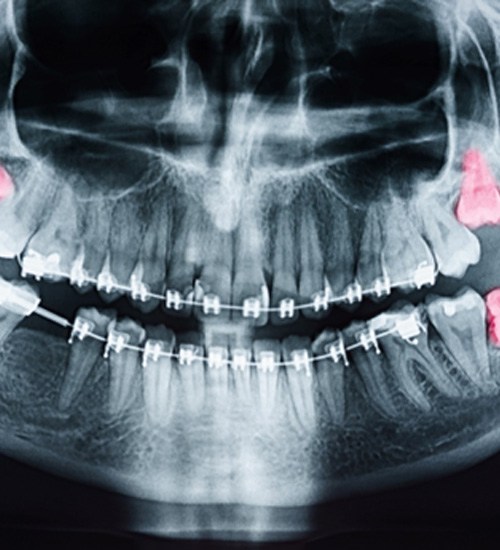 X-ray showing impacted wisdom teeth in San Ramon, CA