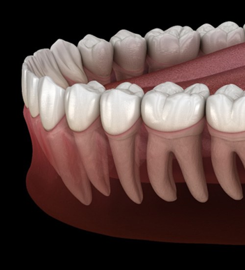 Illustration of impacted wisdom tooth in San Ramon, CA
