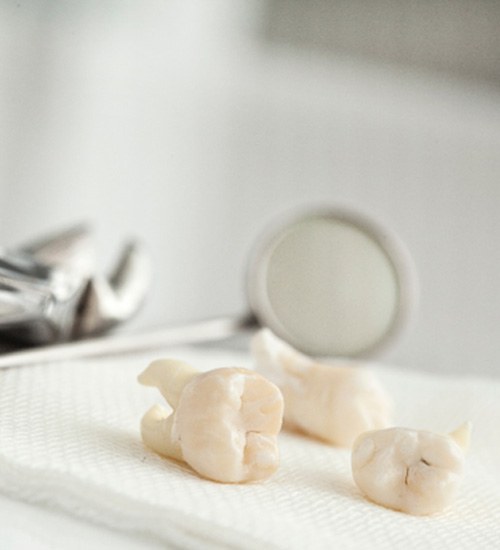 Three extracted wisdom teeth lying next to dental instruments 