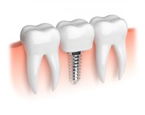 Image of a dental implant.