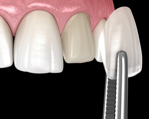 Single veneer being placed on a tooth