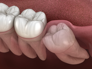 Illustration of an impacted wisdom tooth 