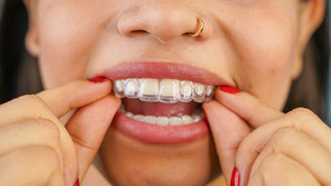 Woman placing clear aligners over top teeth