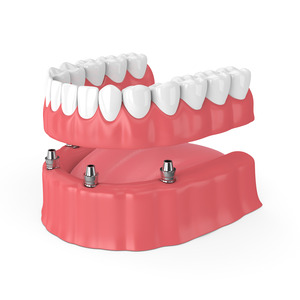 Illustration of a denture being attached to dental implants